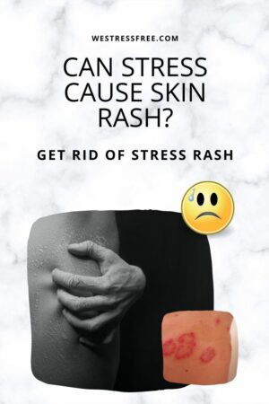 CAN STRESS CAUSE SKIN RASH? - GET RID OF STRESS RASH
