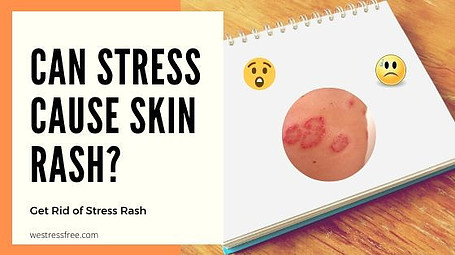 Can Stress Cause Skin Rash? – Get Rid of STRESS RASH | We Stress Free